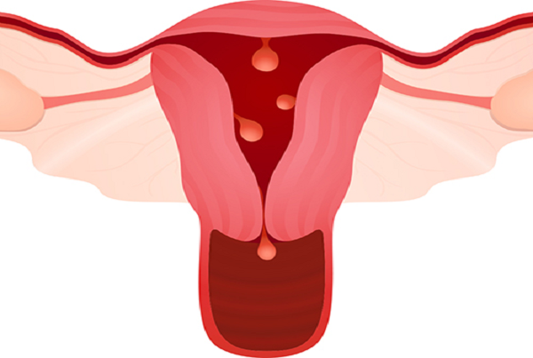 Menstrual Disorders