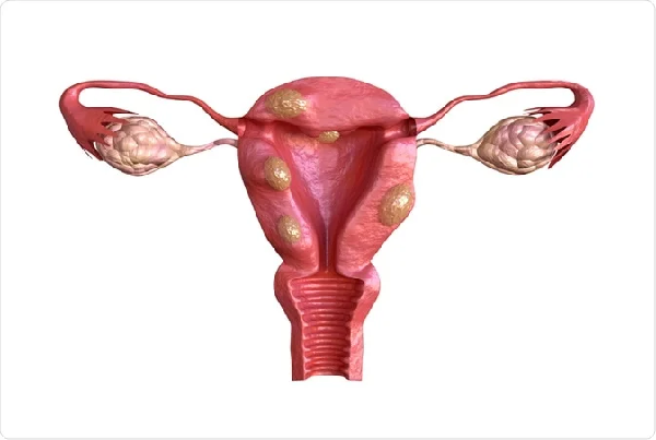 Fibroid and Endometriosis Treatment