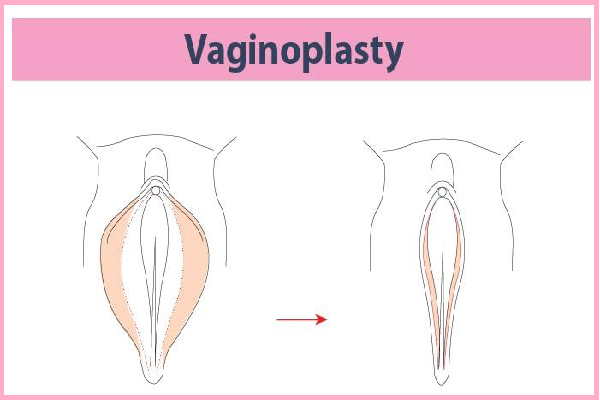 Vaginoplasty