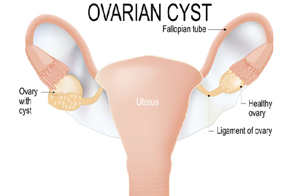 Ovarian Cyst Management